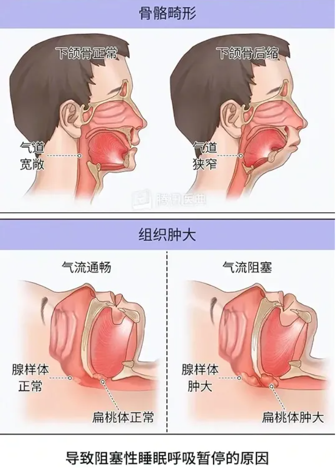 海迪生：听说肥大的腺样体会萎缩，能等吗？扁桃体呢？