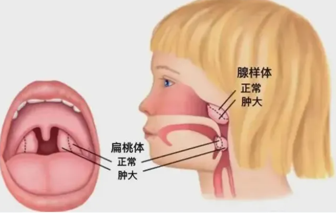 海迪生：听说肥大的腺样体会萎缩，能等吗？扁桃体呢？